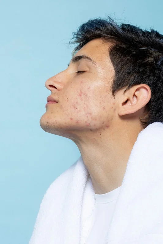 Cryotherapy Treatment To Get Rid Of Acne 2023